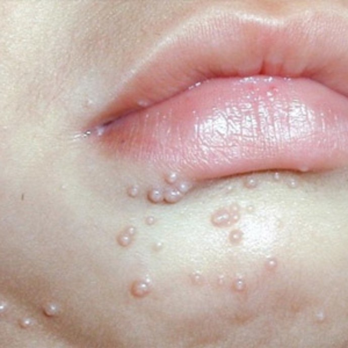 ما هي المليساء المعدية Molluscum Contagiosum؟