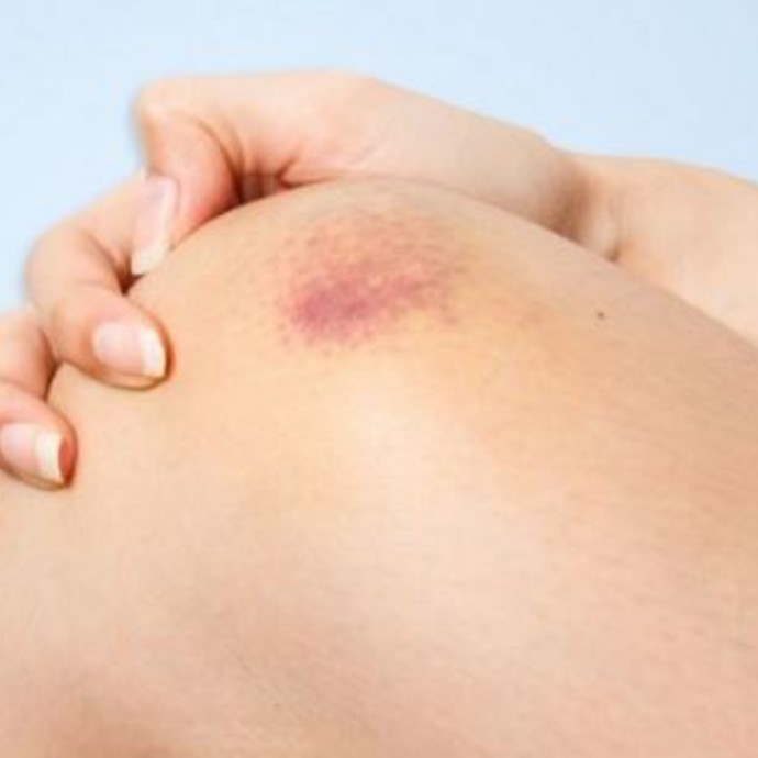 6 علاجات منزلية طبيعية للتقليل من تورم وألم ومظهر الكدمات
