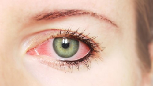 10 وصفات سهلة لعلاج احمرار العين في المنزل