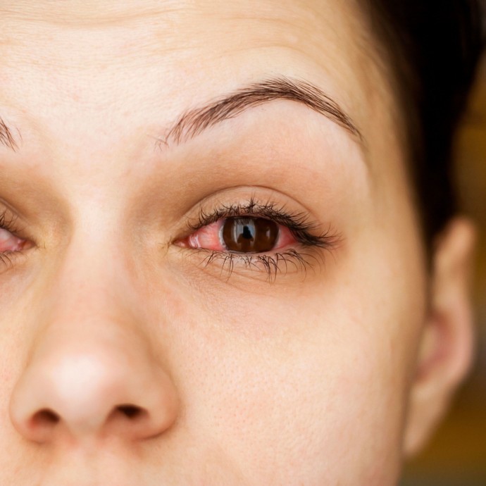 5 علاجات منزلية فعّالة لالتهاب العين