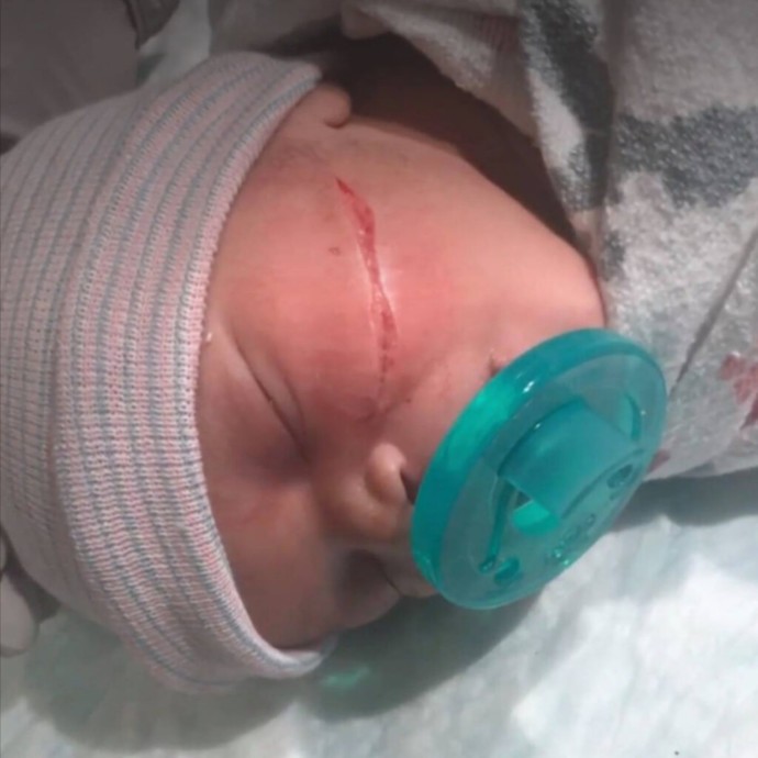 طفلة تولد بجرح ضخم في وجهها والسبب!