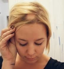 ما هو داء الثعلبة البقعية Alopecia Areata؟