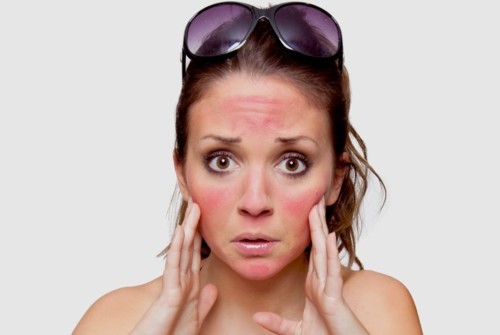 4 طرق لحماية بشرتك من حروق أشعة الشمس!
