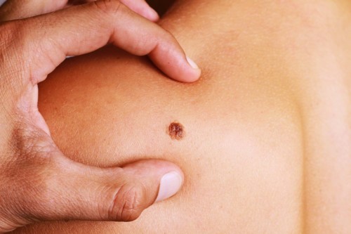 ما هي أعراض سرطان الجلد؟