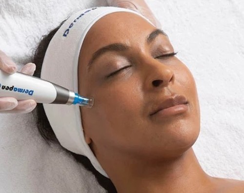 المايكرونيدلنج: كل ما تودين معرفته عن هذا الإجراء التجميلي